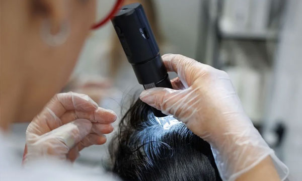 Exosome scalp therapy