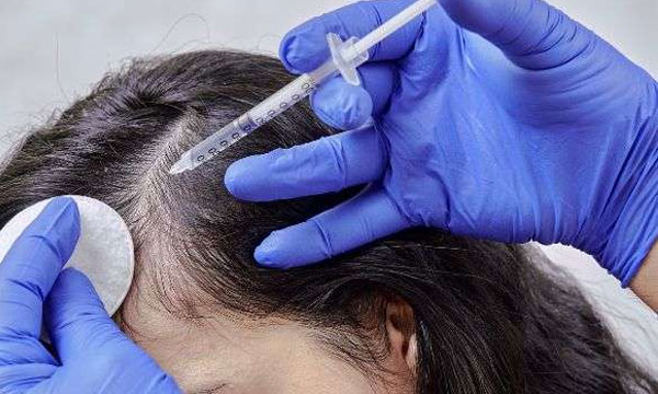 Mesotherapy hair treatment