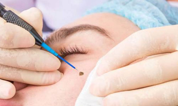 Mole removal treatment