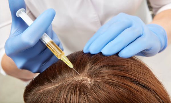 PRP scalp treatment