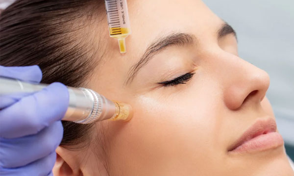 PRP face treatment