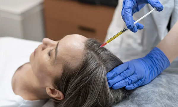 PRP hair treatment