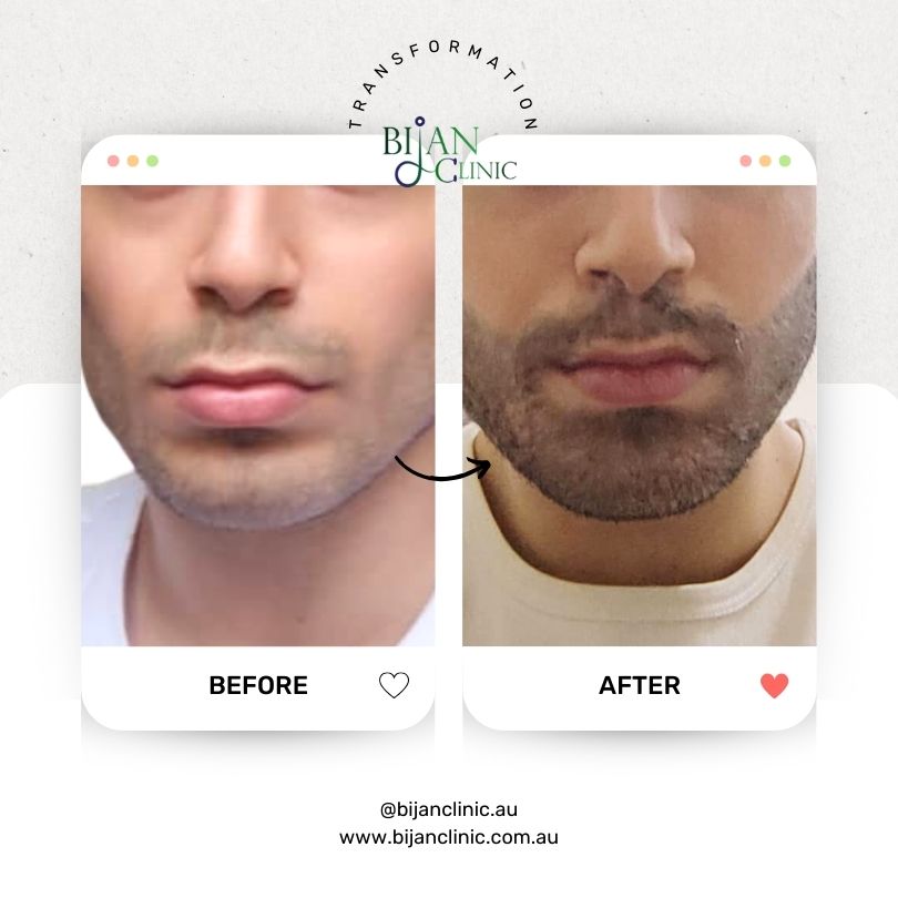 Beard transplant service