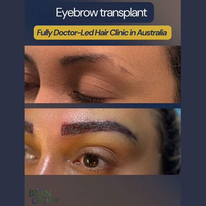 Eyebrow transplant service