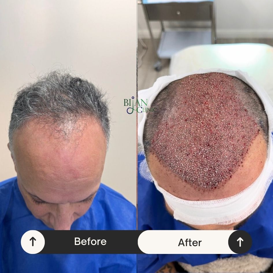 Hair transplant service