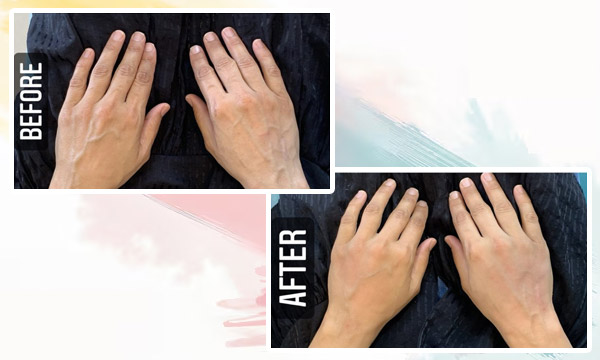 Hand and Face Rejuvenation